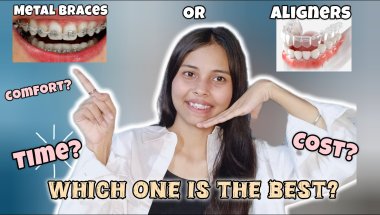 “Braces vs Aligners – Comfort, Cost & Results 💯”