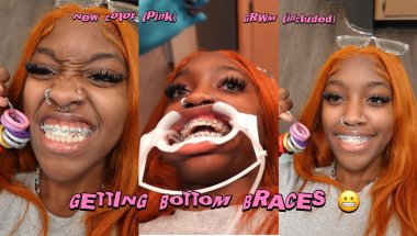 GETTING MY BOTTOM BRACES ON CAMERA ( no pain yet)