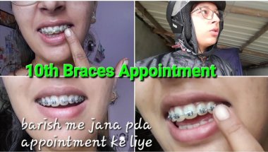 My 10th Braces Appointment 🤩 #bracestreatment #bracestransformation #braces #bracesbeforeandafter