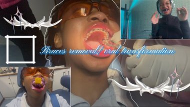 Braces removal/ oral transformation