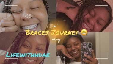 I Got Braces for the First Time 😭✨ | My Honest Day 1 Experience 😬