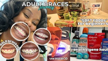 Adult Braces at 29 | GOLD Edition ✨ Whitening, Pricing, Oral Hygiene + Why I Didn’t Get Veneers
