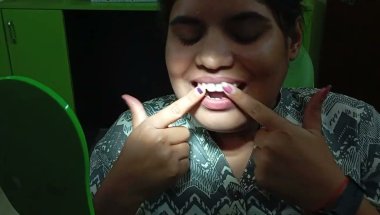 Invisalign for Front Teeth Gap | Clear Aligners | Dr. Abhishek Kumar | Magadh Oro Dental – Patna
