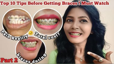 Part 2 Top 10 Tips Before Getting Braces l My Braces experience Cost, Pain, Braces Hurt Smile Result