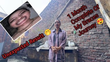 One Month Complete Of Braces 😬 Journey 😍Kaha Or Kyu Lagwaye Maine Braces 😕@Trisha dental Care