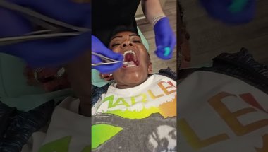 Braces Tightened And Color Change