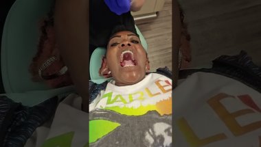 Braces tightened and color change
