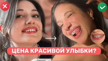 БРЕКЕТЫ: правда спустя 1,5 года — боль, еда, цена, результат
