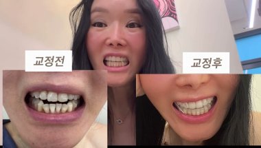 중년교정 #중년교정#인비절라인 #교정전후