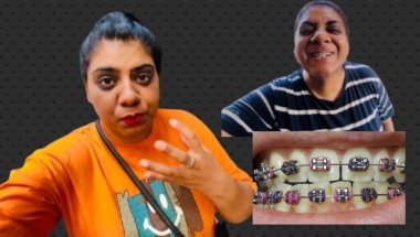 Braces key vjhe sey teeth me drd bhut hue#viralvideo #dentist