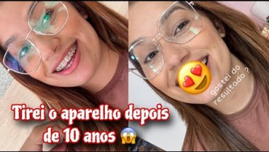 tirei o aparelho 😬 + de 10 anos de uso  #aparelho #make