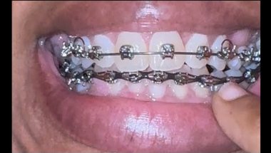 THIS PART OF BRACES HURT