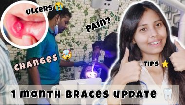 Braces Journey: 1 Month Update 🦷 | Pain, Struggles & Changes🤯