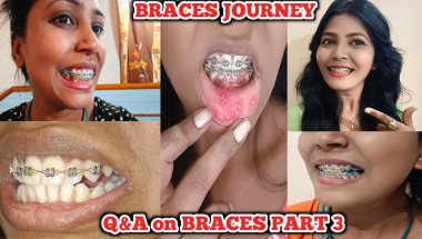 Braces: My Honest 17 Months Review! 10 Things I Wish I Know BEFORE Getting Braces Part 3 #braces