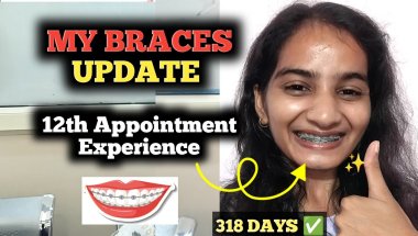 The Pain of Elastics : My Braces Journey!😱