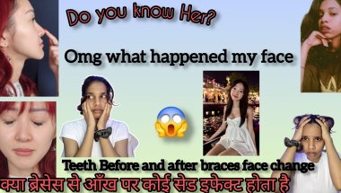Teeth before and after braces face change II and 👀 Eyes Said effect 😱 ll @ClaraDao  this girl...omg?