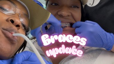 Braces Update: O-Ties or Wire ties, both hurt!