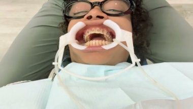 My Dentist told me a secret. Tighten My Top Braces and Start My Bottom Braces for the First Time