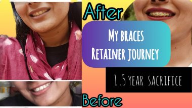 My braces journey 😍#adaywithkhushi