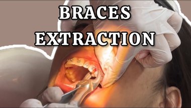 Braces extraction explained | kaise nikalte hai daant| The Braces Dentist