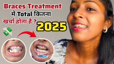 🦷🤑 Braces Cost in India 2025 || Metal braces का पूरा खर्चा कितना होता है || Hidden Charges #trending