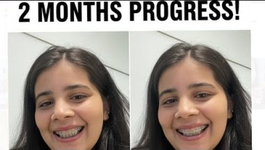 🦷🤑2 Months braces update#viral #vlog #minivlog #trandingshorts #trending #viralvideo #viralchallenge