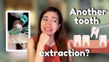 September Braces Update | Tooth extraction | Teeth Gaps | Wires