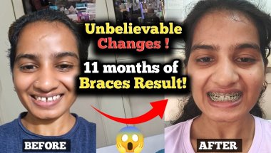 Braces Results After 11 Months: Gaps Closed!