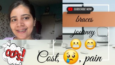 Braces🦷🦷 lagwane se pehle jaan lo ye baat 🦷😨#viral #viralvideo #trandingshorts#shortvideo #minivlog