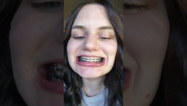 It's the braces update 9/25/25