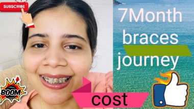 7 months braces journey 🦷#teeth #braces #viral #trending #minivlog #vlog #top #viralvideo #shortvide