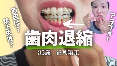 【ヤバい】歯列矯正中に【歯肉退縮】になった原因|アラフォー・アラサー【表側ワイヤー矯正】braces  before & after