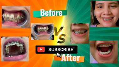 Before & After braces treatment😱 #viral #vlog #trending #teeth #braces #viralvideo #description