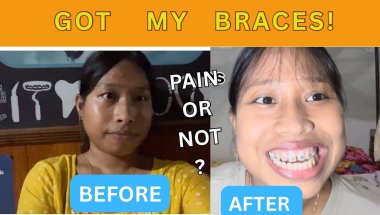 Braces journey: what it’s really like after getting them ( 1st day braces experience)