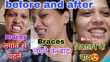 Braces Before and After 😍 | 14 months ka journey रंग लाया🤗| @sandhyatiggavlog8809