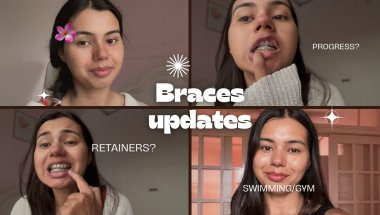 5 Months with Braces! Progress, Struggles, Retainers + Life Update (Gym, Swimming & More)