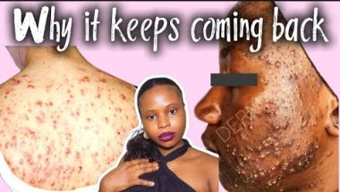 The Real Reason Your Acne Won’t Go Away (And How to Fix It)