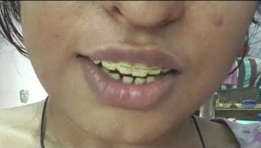 My forth appointment 🙆‍♀️❤my experience!? Touguecrip #dentalbraces  #trending #bracestransformation
