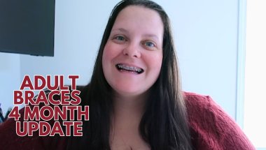 Adult Braces Journey | 4 Month Update