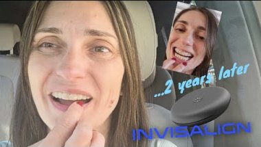 My Invisalign Is NOT Going as Expected 🤯| 2 Years Journey Update #Invisalign #progress