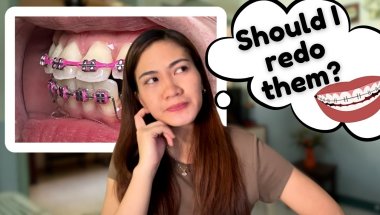 Thinking About Getting Braces Again? Watch This First!