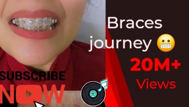 Braces journey #viral #trending #teethdecay #braces #minivlog#youtuber #description ##viralvideo