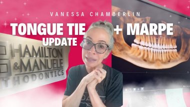 Media 'Still on the road with my tongue tie + MARPE expansion journey' in category 'Expander (RPE)'
