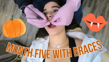 Braces Update Five! 🦷 (Completing my fifth month with braces)
