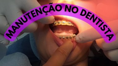 MANUTENÇÃO NO DENTISTA | MEU APARELHO NO DENTE