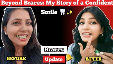 Braces Update ll Finally! My Confident Smile Transformation After Braces (2025 Update)