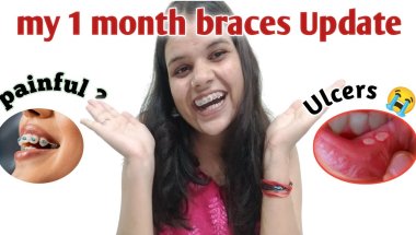 Braces Journey 1month update  pain, struggles & changes🤌
