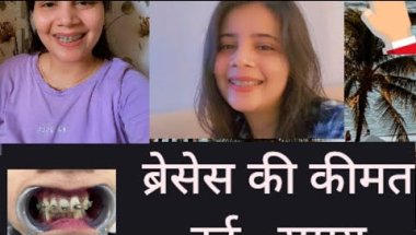 Braces update #viral #trending #teeth #braces #viralvideo #vlog #dentalbraces #smiledesigndental