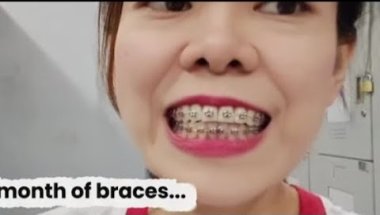 2 MONTHS OF BRACES