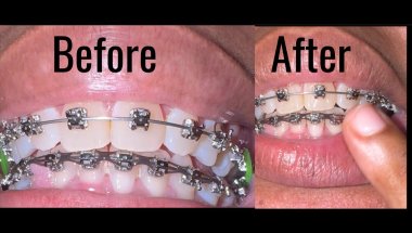 BEFORE & AFTER TEETH CLEANING